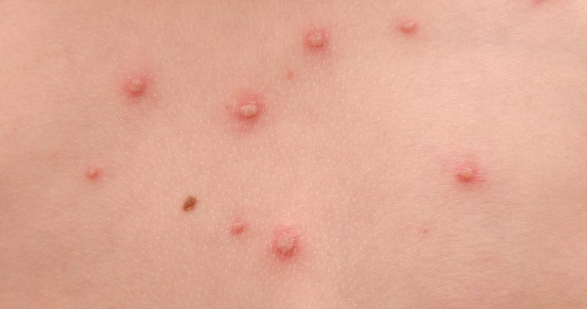 Sep : attention à la varicelle et au zona sous fingolimod